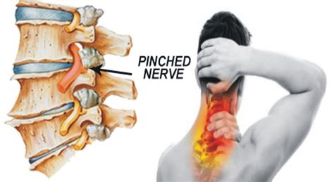 neck pain symptoms pinched nerve neck