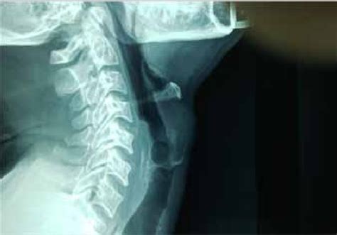 Neck Rings X Ray