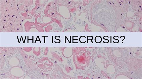 necrosis medical terminology definition