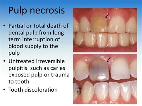 necrosis of pulp pulpal gangrene adalah