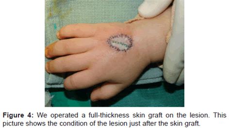 necrosis of skin graft