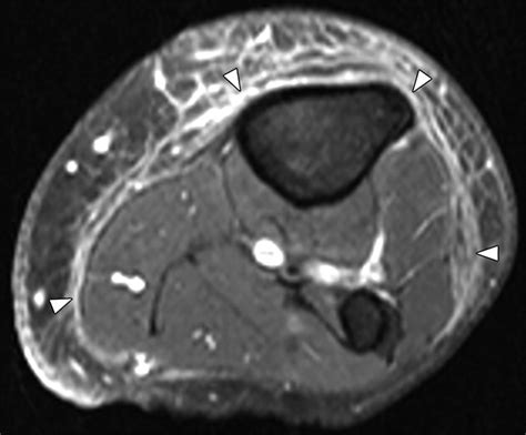 necrotising fascitis and mri finding