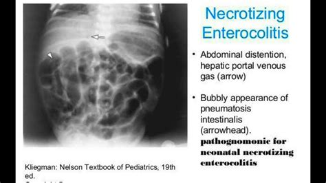 Necrotizing Enterocolitis Pediatric Radiology Reference Article