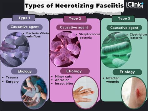 necrotizing fasciitis bacteria pictures