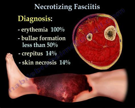 necrotizing fasciitis bacterial symptoms
