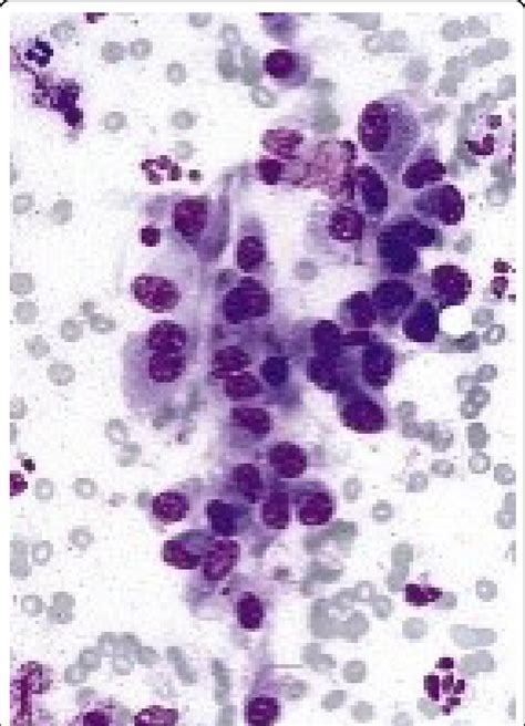Needle Aspiration Mastitis