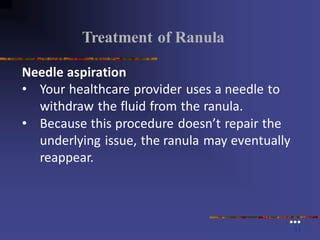 Needle Aspiration Ranula