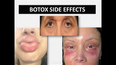 negative side effects of botox injections to the face