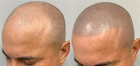Neglecting aftercare with scalp micropigmentation