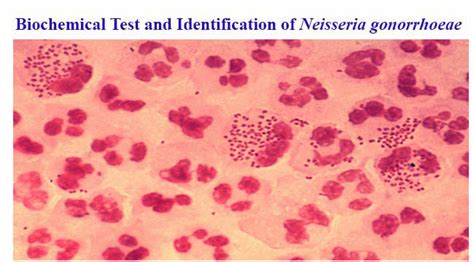 Culture of Neisseria gonorrhoeae (Ng) from a male urethral swab