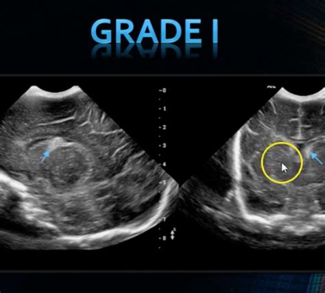 neonatal head ultrasound ivh