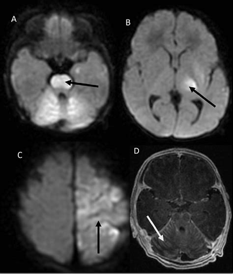 neonatal hsv meningoencephalitis