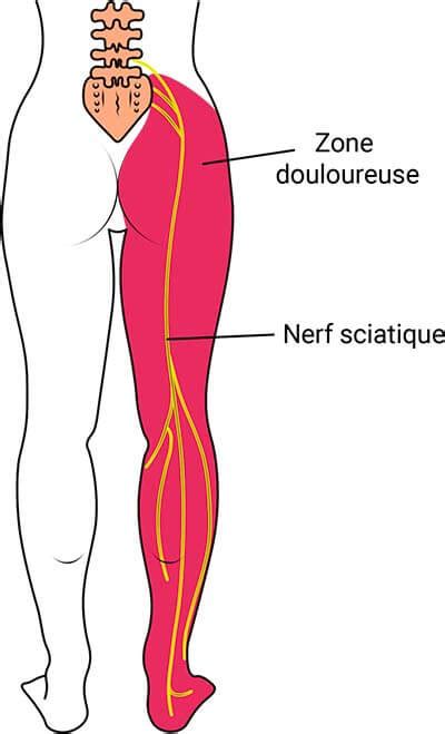 Nerf Sciatique Images