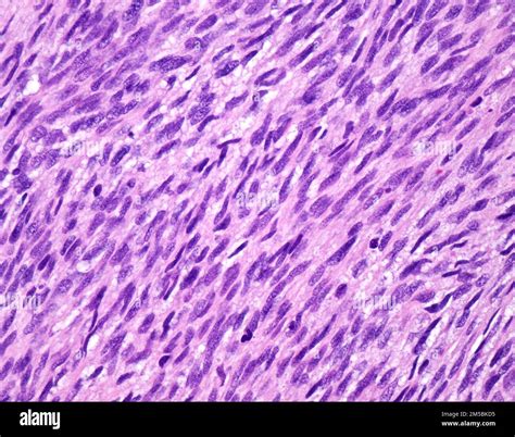 nerve sarcoma