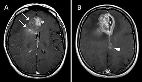 neuroendocrine carcinoma metastatic to brain