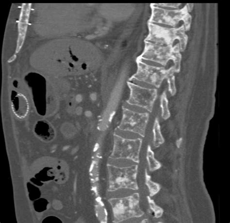 neuroendocrine tumors bone metastases