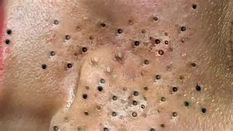Loan nguyen acne treatment and removal blackheads (954) loannguyen 
