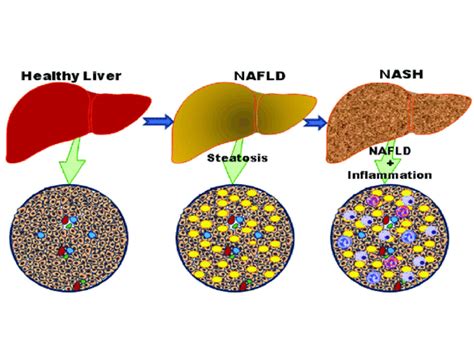 new drug for fatty liver disease