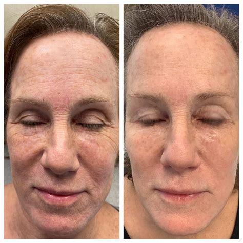new facial rejuvenation procedures