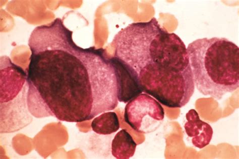 new fda approved drug for multiple myeloma