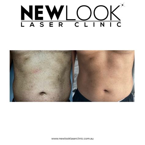 new look laser clinic