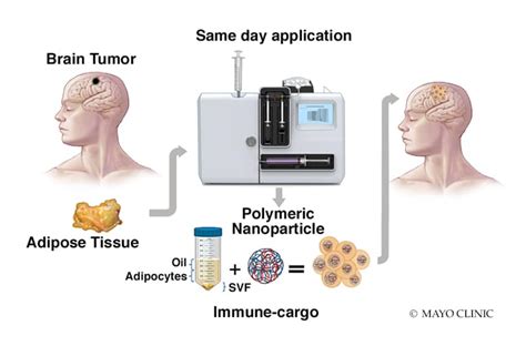 new treatment for glioblastoma 2020