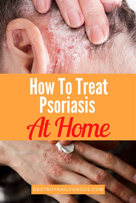 new treatment for psoriasis 2022