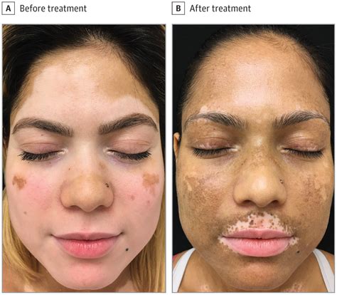 new vitiligo treatment repigmentation