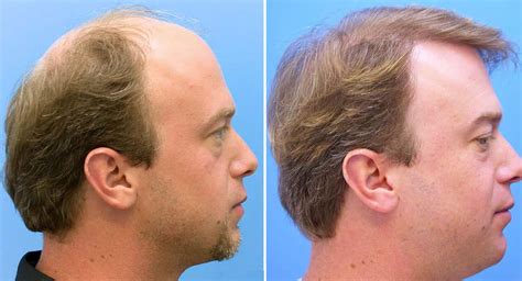 Hair Restoration For Men Dr. David Rosenberg