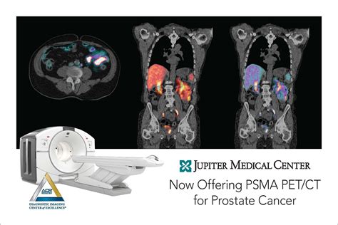 newest pet scan for prostate cancer