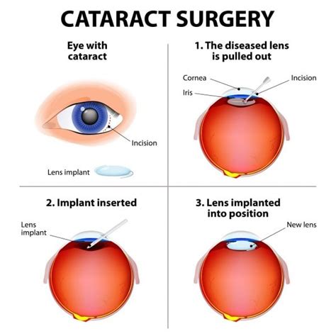 nhs cataracts symptoms and treatment