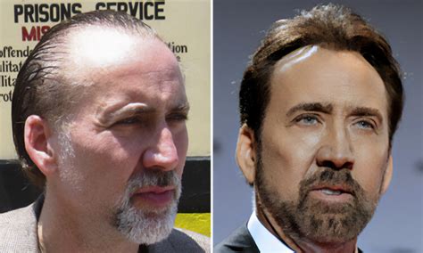 nicolas cage hair transplant