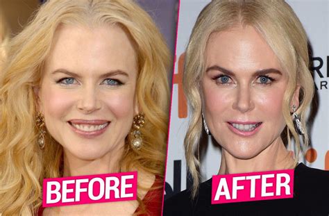 nicole kidman facial surgery