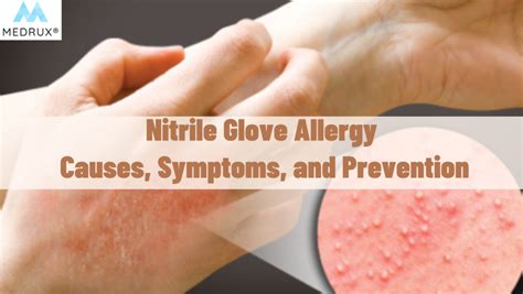 Nitrile Glove Sensitivity