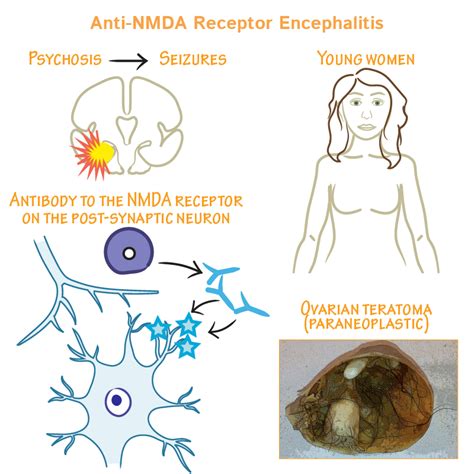 NMDA Receptor Encephalitis Explained