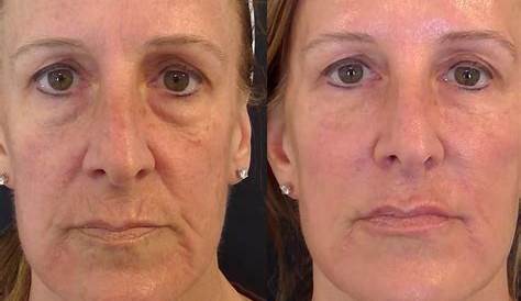 Nonsurgical Facelift Hill Street Clinic