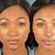 non surgical nose job before after african american