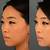 non surgical nose job before and after asian