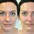non surgical nose job before and after big nose