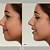 non surgical nose lift before and after