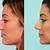 non surgical nose reshaping near me
