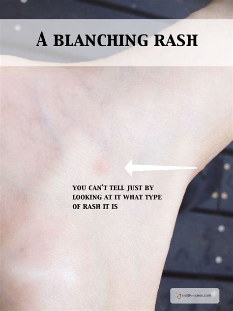 non blanching rash meaning