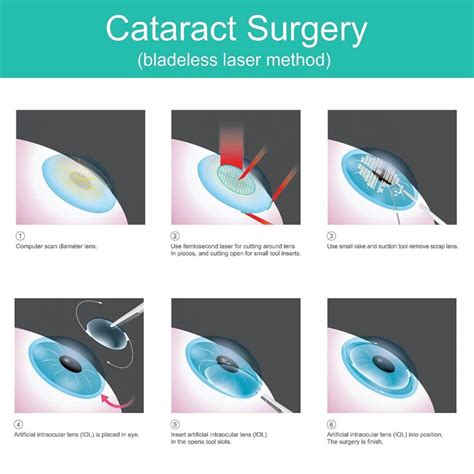non surgical cataract removal