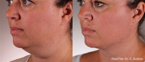 non surgical facelift los angeles