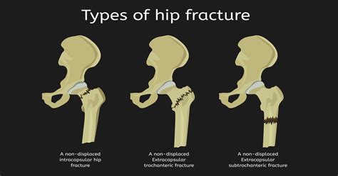 Hip Elmhurst Orthopaedics