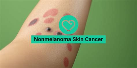 nonmelanoma