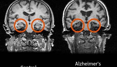Normal Brain Mri Vs Dementia Frontotemporal
