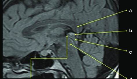 Normal Pineal Gland Mri , Sagittal MRI Stock Image C030/6313