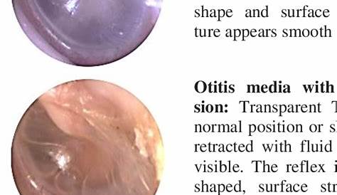 Normal Tympanic Membrane Vs Otitis Media Ch 15 Exteranl Ear