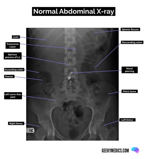 Normal Abdominal X Ray Labeled